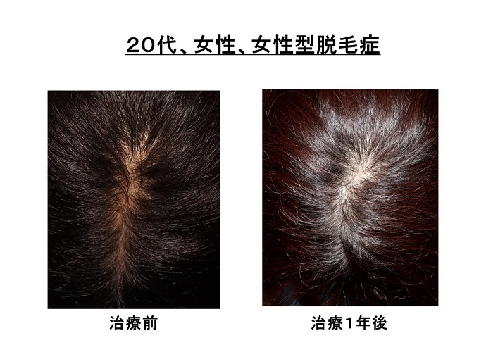 円形脱毛症　病院